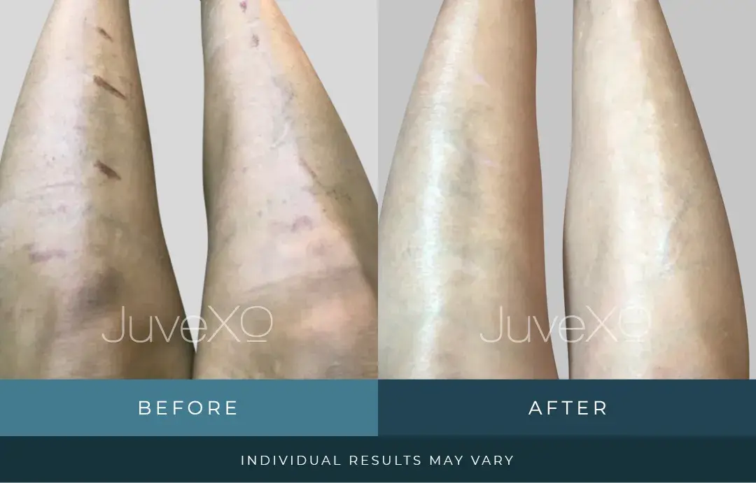 xolift_beforeafter_patient_a.jpg