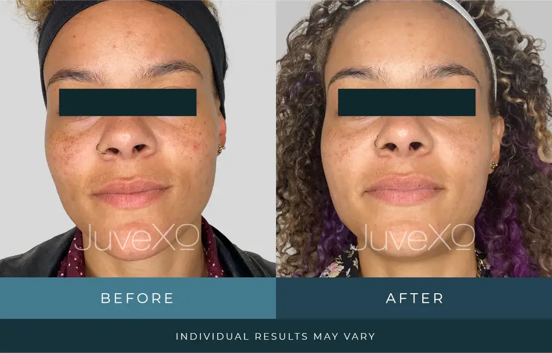 xolift_beforeafter_patient_g.jpg