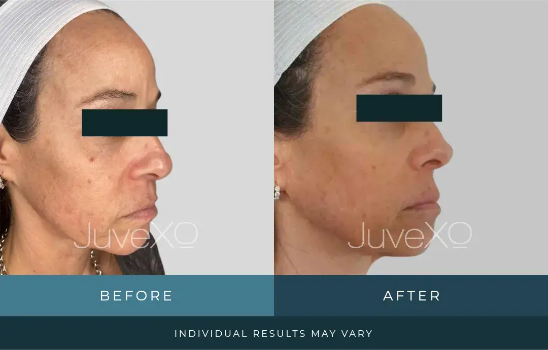 xolift_beforeafter_patient_h.jpg