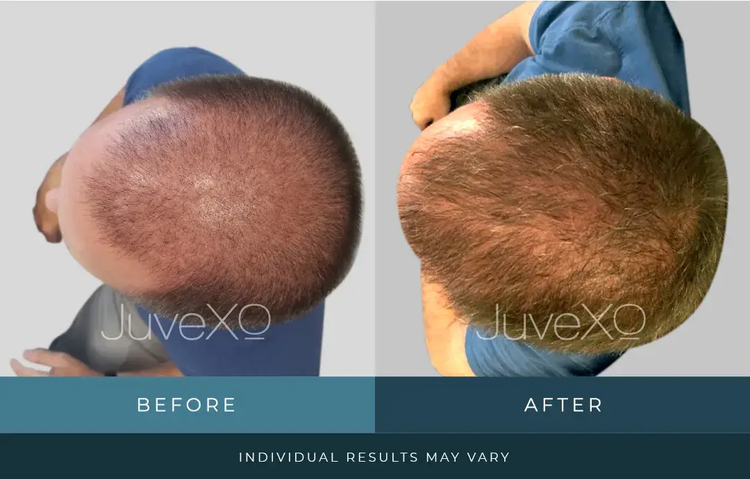 xolift_beforeafter_patient_i.jpg